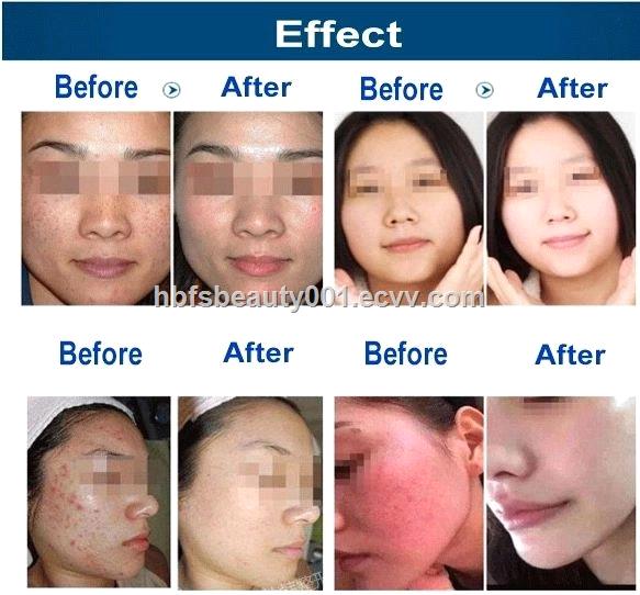 H2O2 small bubble Water Oxygen Jet Peel Hydra Beauty skin Cleansing Hydra Dermabrasion Machine