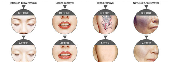 Portable Qswitch NdYAG Laser Tattoo Removal Pigmentation Removal Carbon Peeling Machine