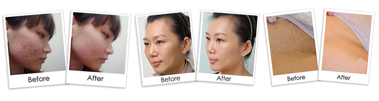 IPL SHR Laser Hair Removal Device