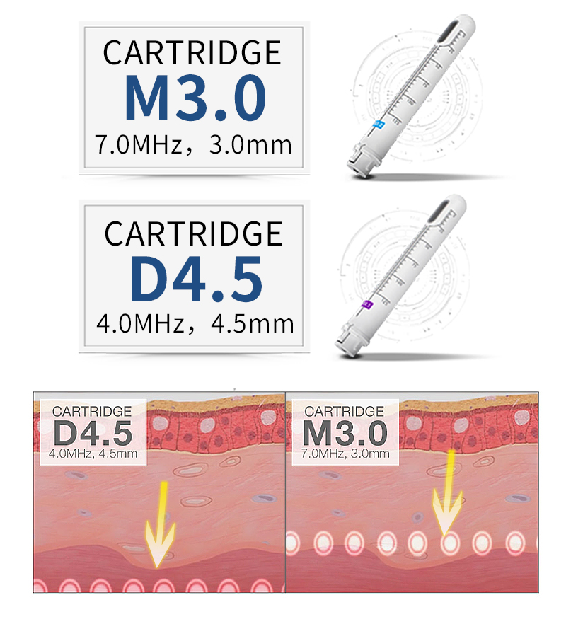 Vaginal Tightening HIFU Machine for Women Beauty with Good results