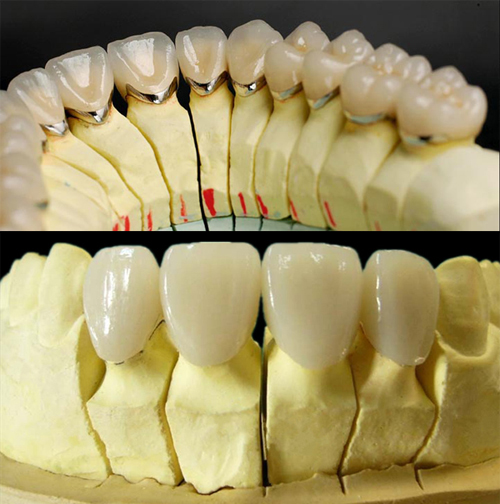 CROWNS BRIDGES ALL CERAMICS Zirconia Layered