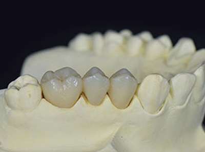 UltraTranslucent Zirconia China dental zirconia crowns