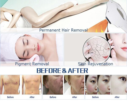 HKS801 Portable IPL Hair Removal Beauty Machine